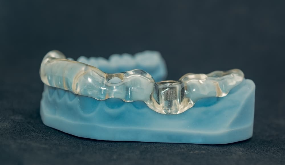 Dental Implant Recovery