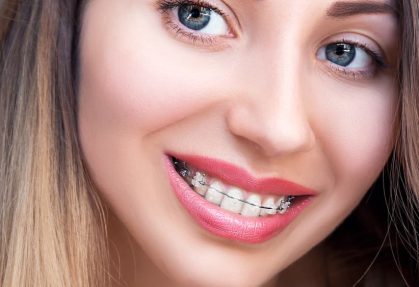 Damon Braces for Adults Seeking Orthodontic Treatment