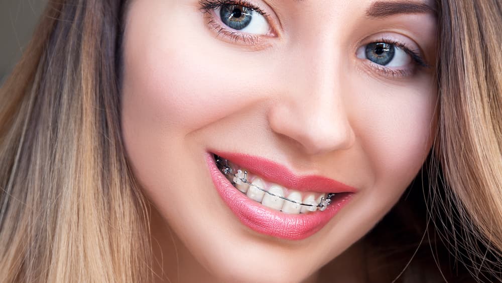 damon braces
